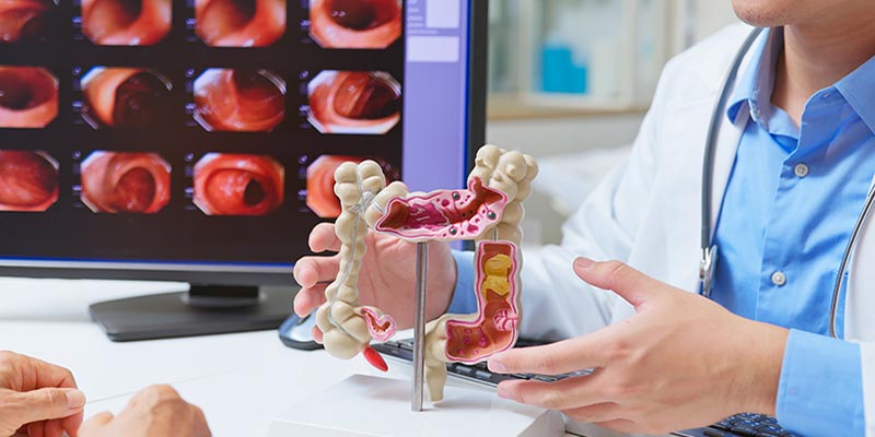 colorectal cancer